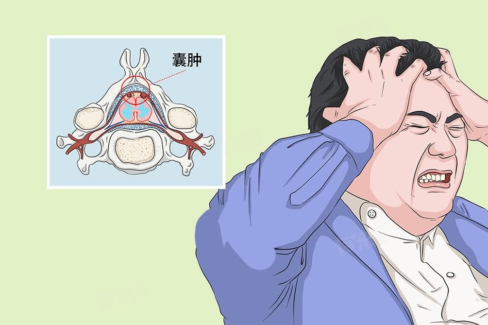 右侧颞极蛛网膜囊肿是什么病