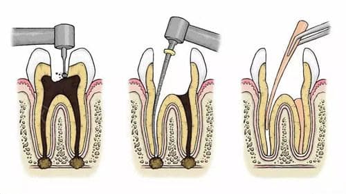 牙齿带牙冠能长久使用吗?戴牙冠里面牙齿会烂掉吗?