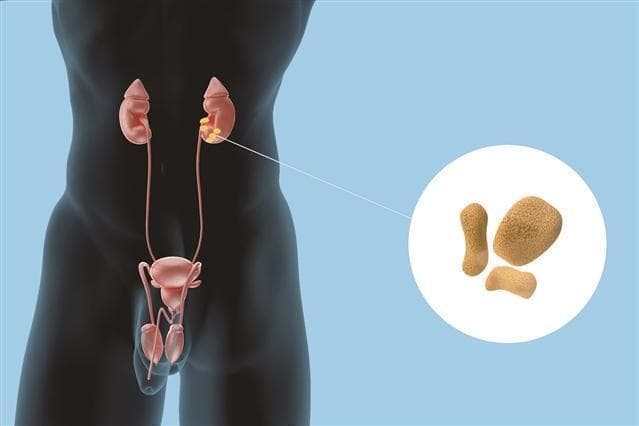 预防泌尿系统结石，健康生活方式很重要