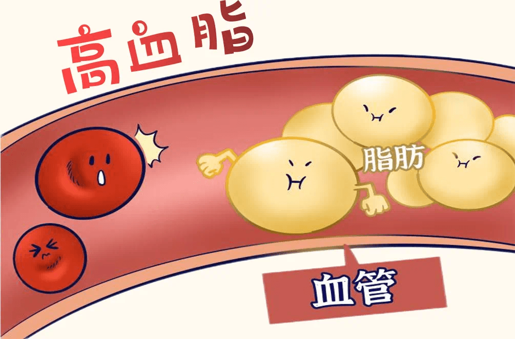 罪魁祸首——高血脂