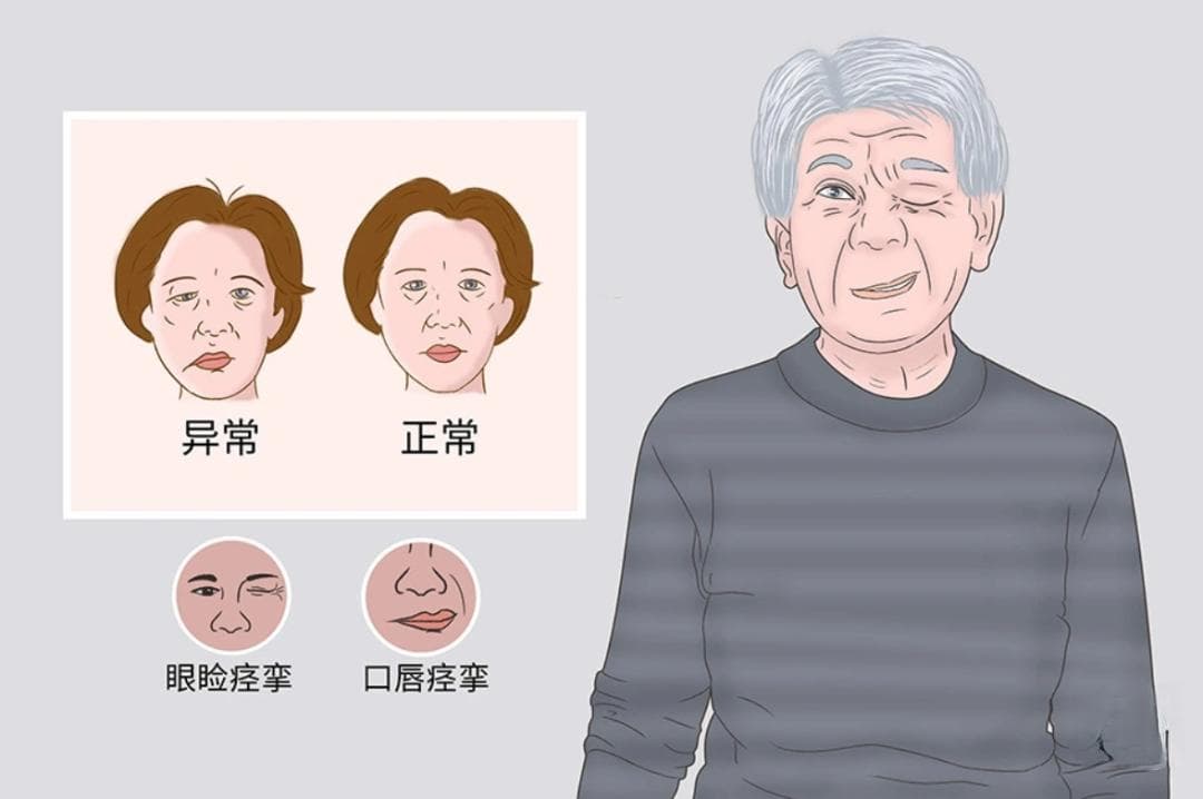 关于梅杰综合征，你真的了解吗？