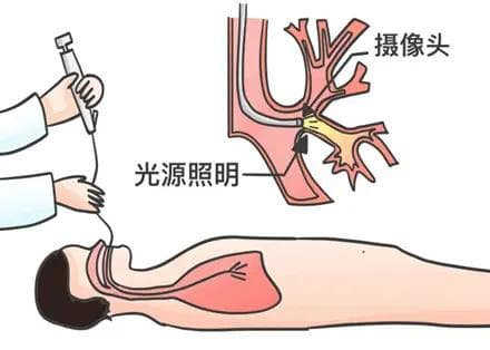 支气管镜“探险”，麻醉让你“零痛感”