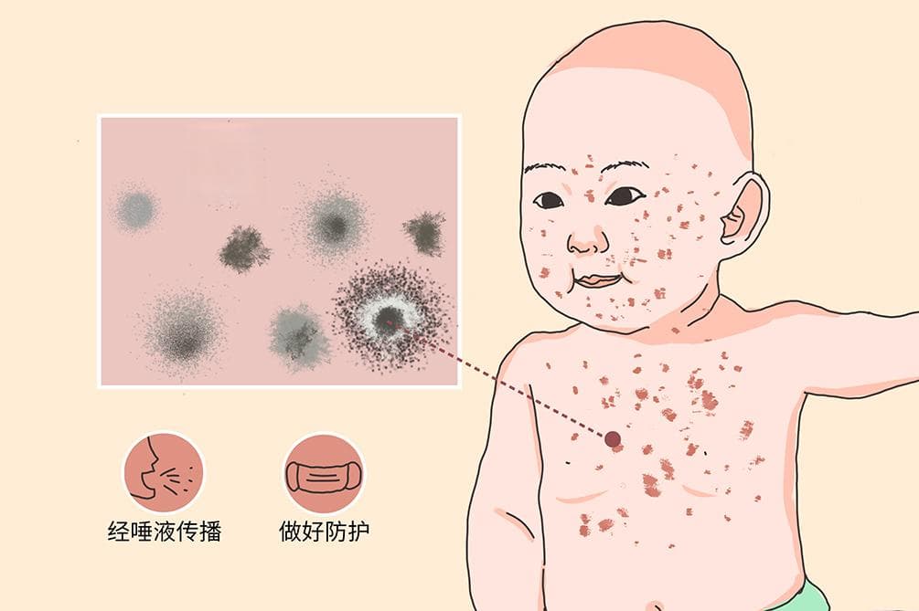 幼儿急疹：病因、症状、诊断与治疗全解析
