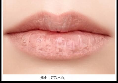 秋冬唇炎高发期，口腔科医生送你一份护唇秘籍！