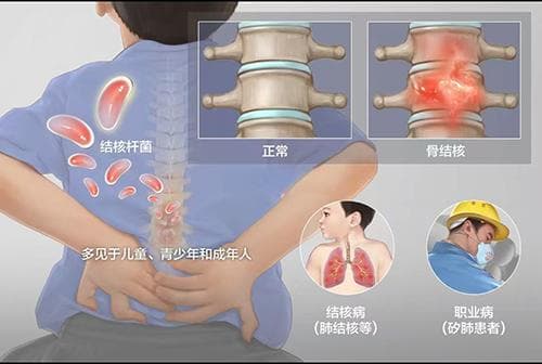 【健康科普】肺外结核健康宣教