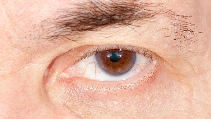 眼袋可以通过睡眠改善吗？全方位解析眼袋成因与改善方法