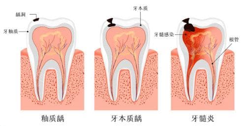 后槽牙一咬合就疼是怎么回事？考虑牙周炎/根尖周炎/牙髓炎的可能~建议及时治疗！