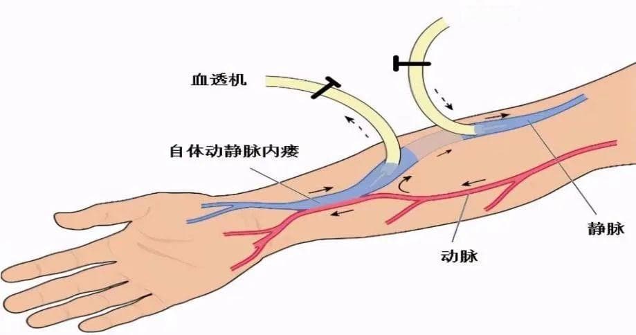 血透患者内瘘血肿淤青的处理小妙招