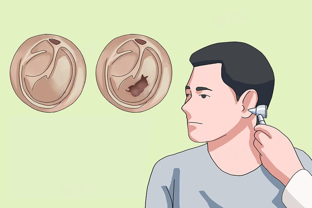 耳膜穿孔：成因、症状与治疗全解析
