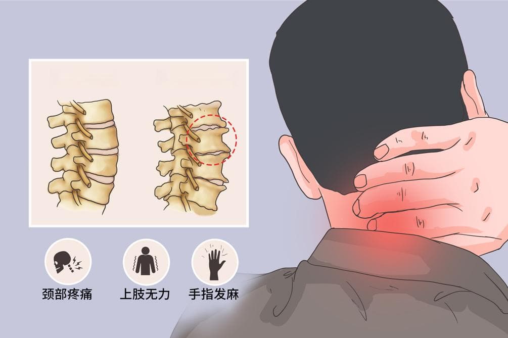 颈椎退行性变