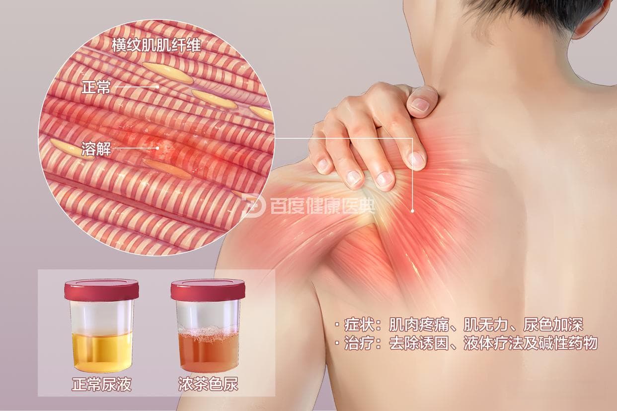横纹肌溶解综合征发病原因多样，及时治疗可避免肾损伤