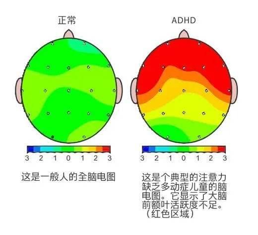 ADHD儿童的大脑"电波密码":解码多动背后的神经信号