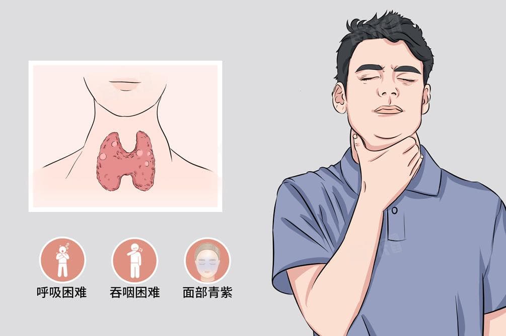甲状腺结节总觉得嗓子有异物
