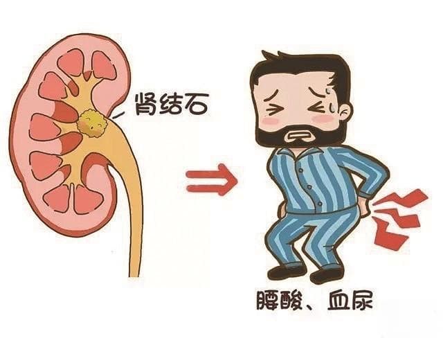 早发现早治疗 远离泌尿系结石