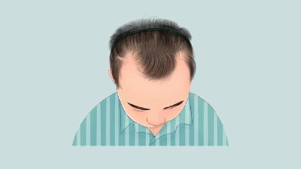 发际线后移怎么恢复