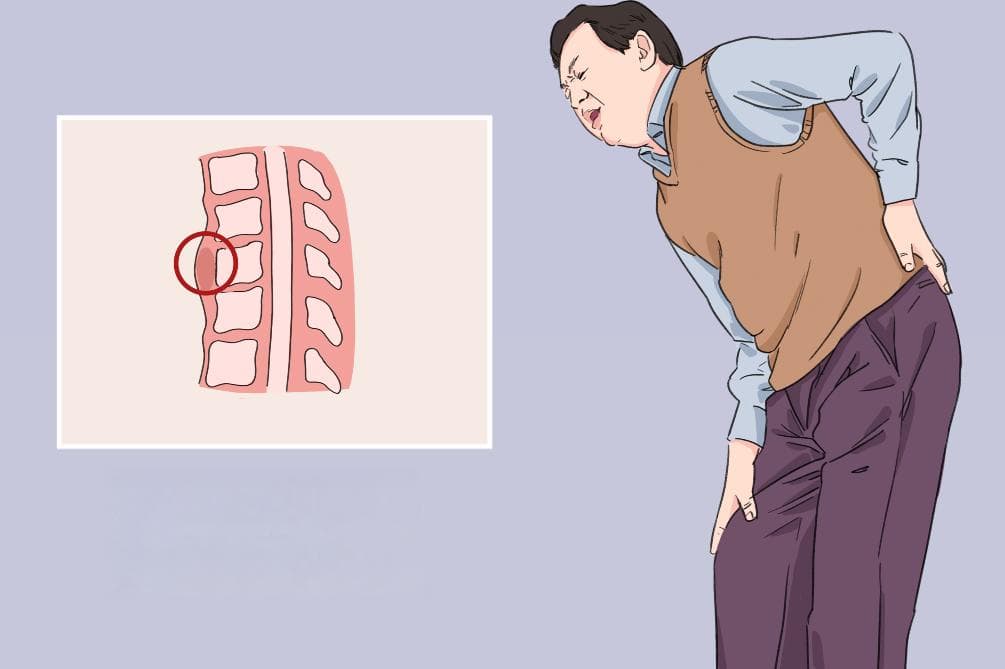 脊椎结核：病因、症状、诊断与治疗全解析