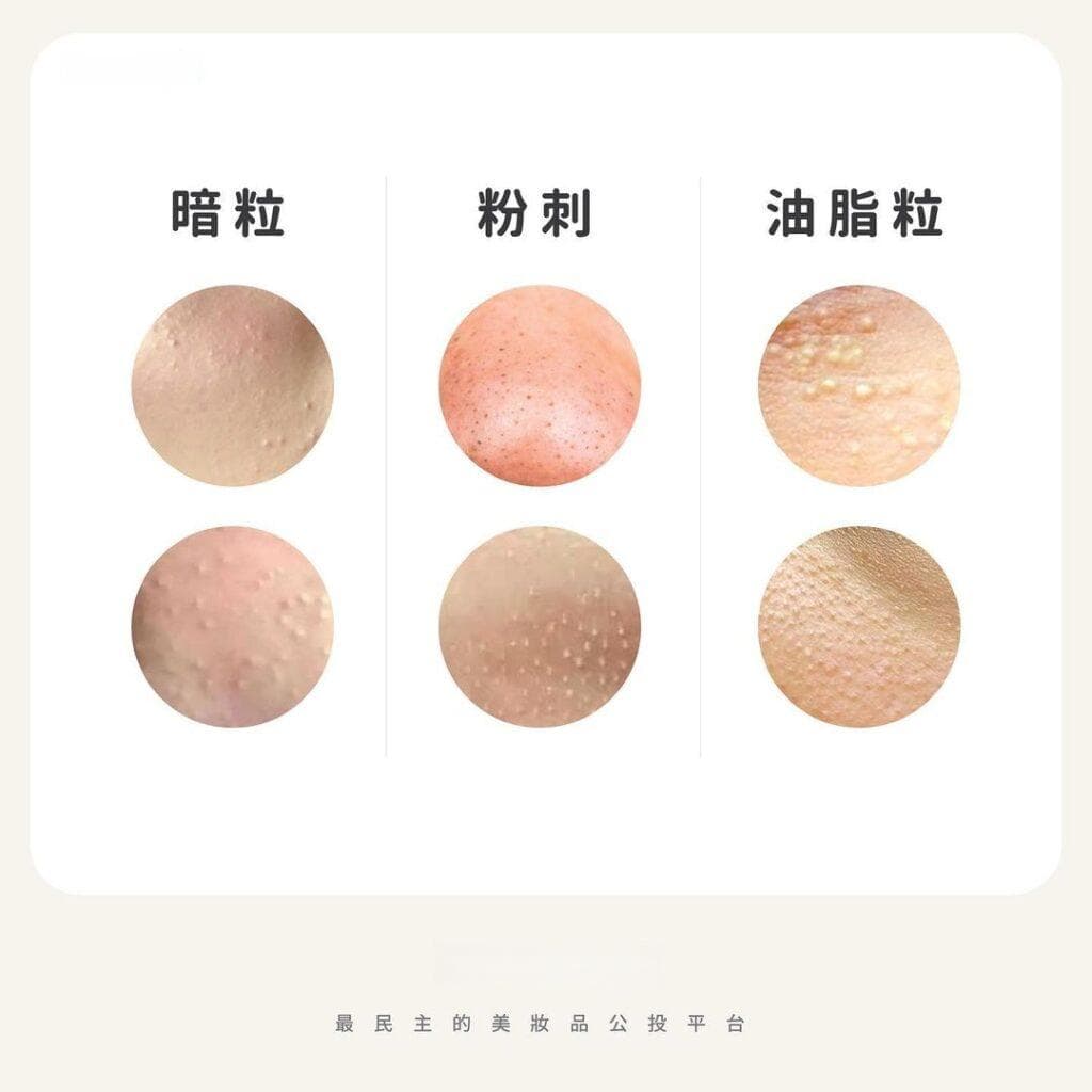 【暗粒】10大去暗粒產品推薦！了解原因及處理方法