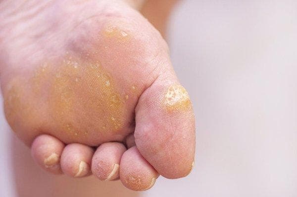 足癣用什么药膏效果好