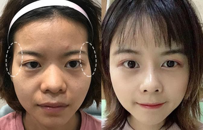 太阳穴凹陷怎么办？选玻尿酸还是自体脂肪？