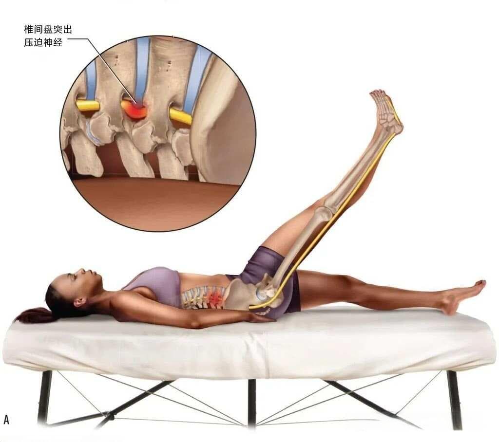 坐骨神经痛与梨状肌综合征的康复方法