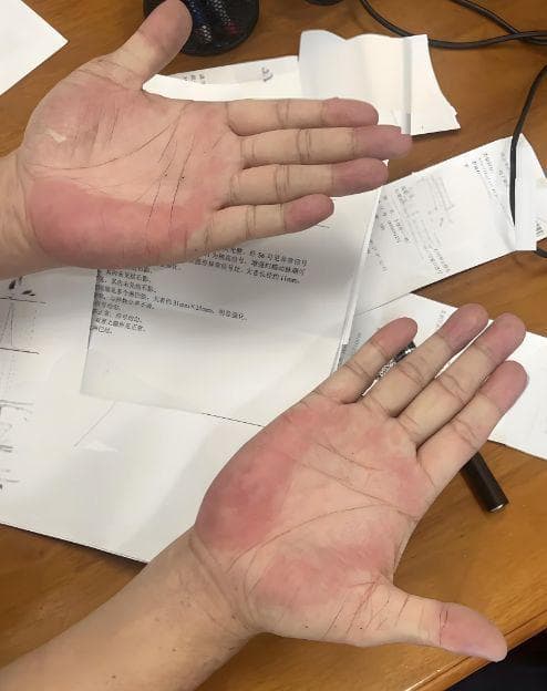 乙肝患者要警惕，5个导致恶化的“红线”，不要碰