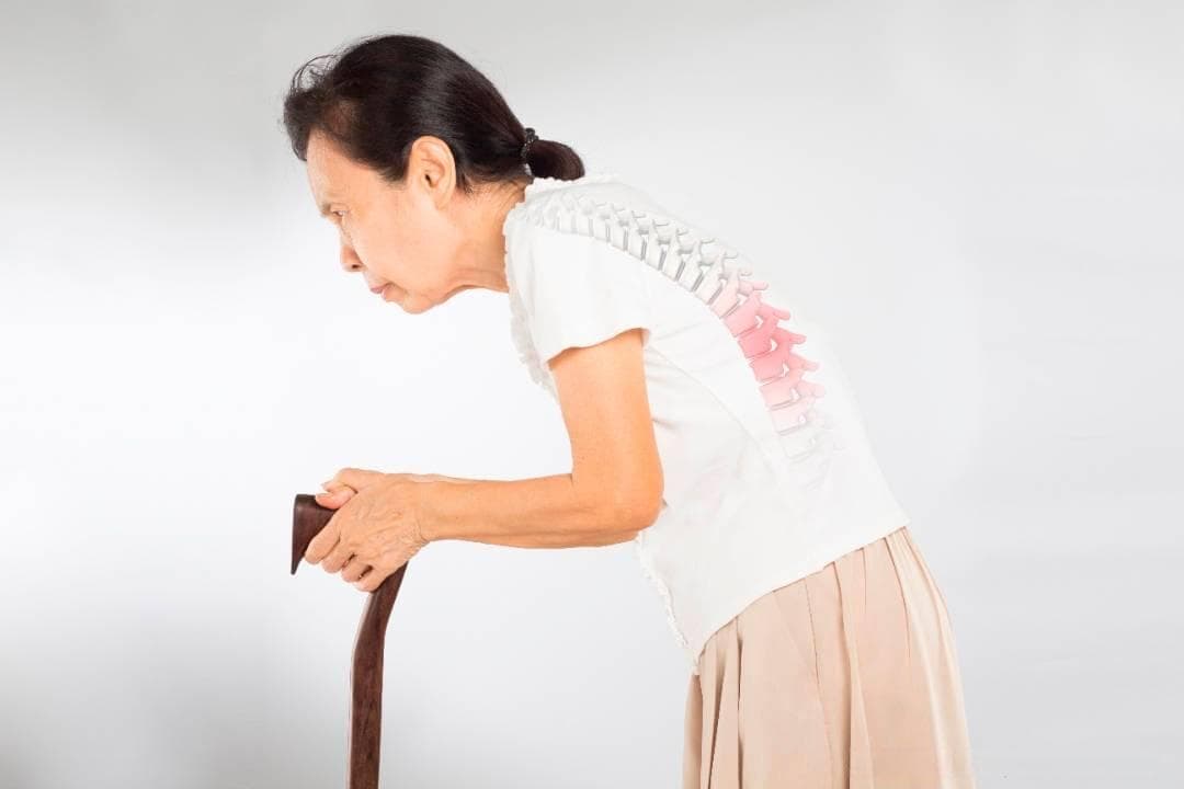 骨质疏松、驼背与ACC钙：关注骨骼健康，预防老年畸形
