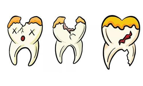 蛀牙修复多少钱一颗?蛀牙治疗大不同:不同材料、技术决定你的钱包厚度