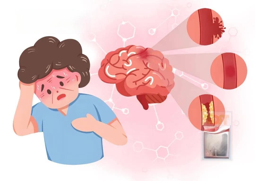 中风常见原因大揭秘，对于预防和早期干预至关重要
