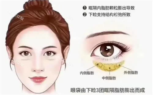 888元去眼袋可信吗？有风险，附上一线/二线/三线城市去眼袋的正常价格