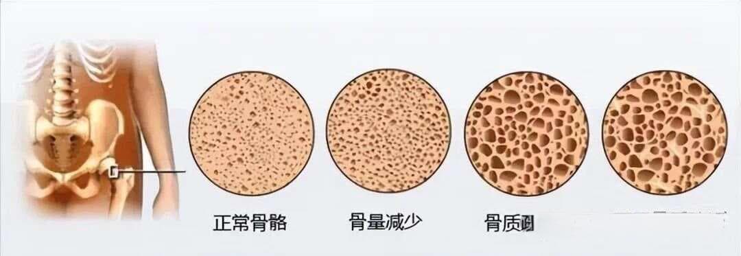 骨代谢标志物助力骨质疏松精准诊疗，三大类指标全解析