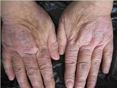皮肤科医生手记：手部湿疹常见问答