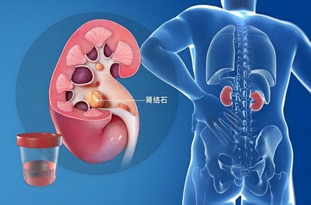 肾结石不再难！金钱草颗粒新研究，排石效果引热议