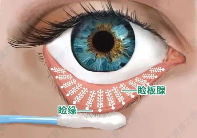 别让眼睛“油尽灯枯”——揭秘睑板腺功能障碍