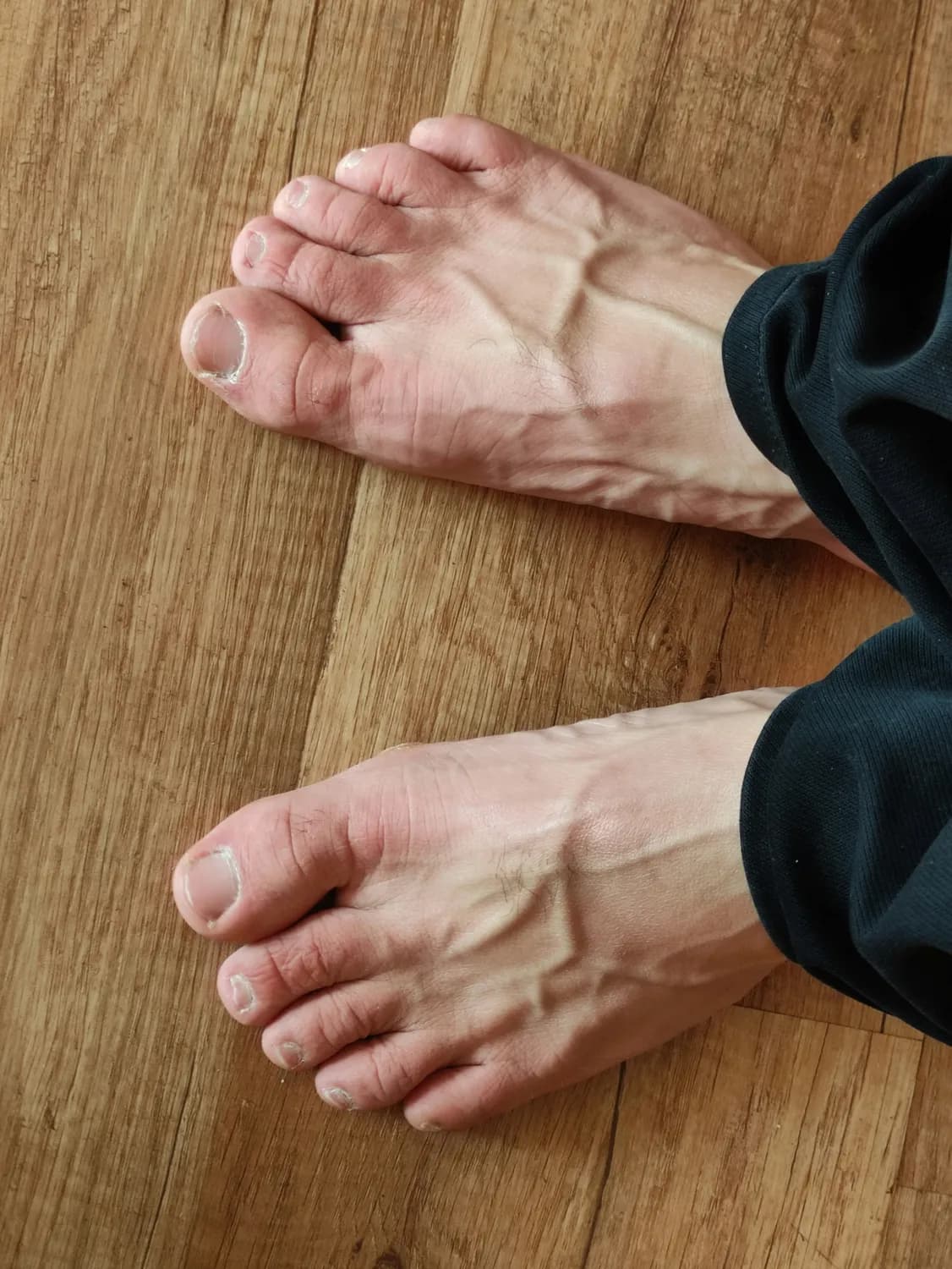 跑步爱好者必知：如何预防跖痛症？