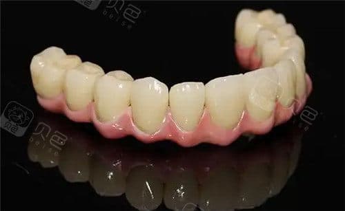 种牙好还是做连桥冠好？哪种更适合你？本文对比分析给您提供一些思路
