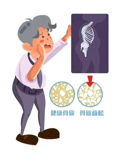 5款抗骨质疏松、预防骨折的关键药物，一文读懂