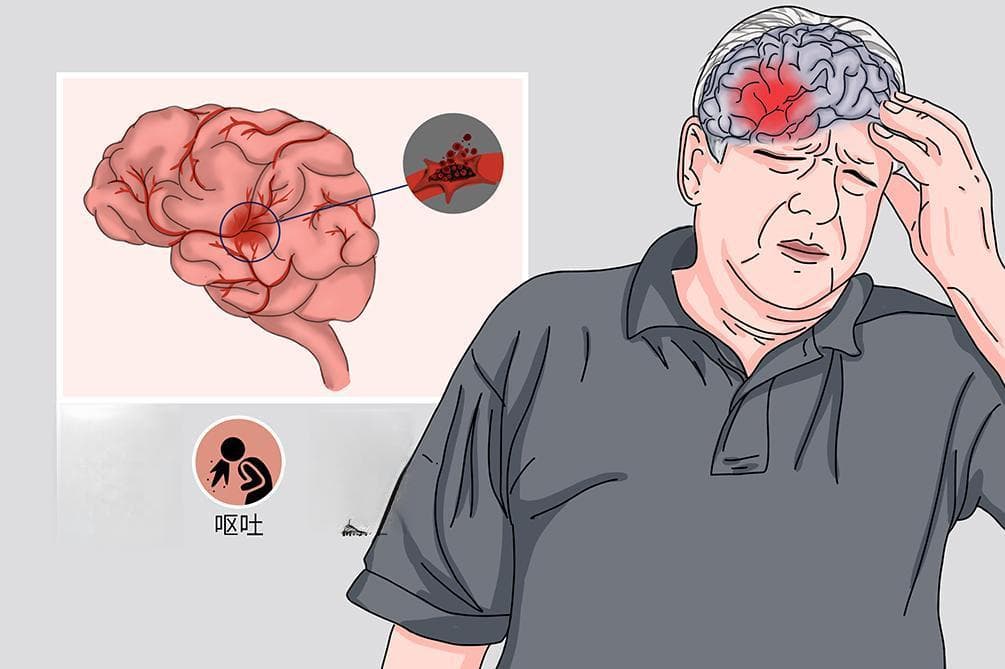 脑出血患者的体位管理指南