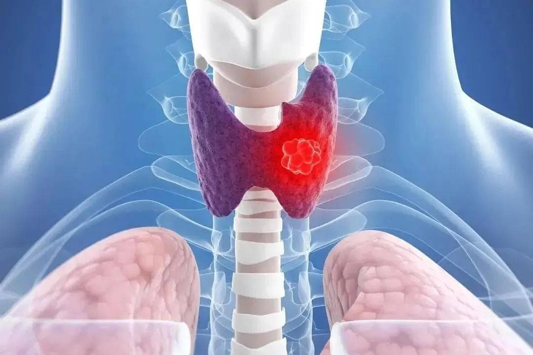 甲状腺结节的治疗方法有9种？