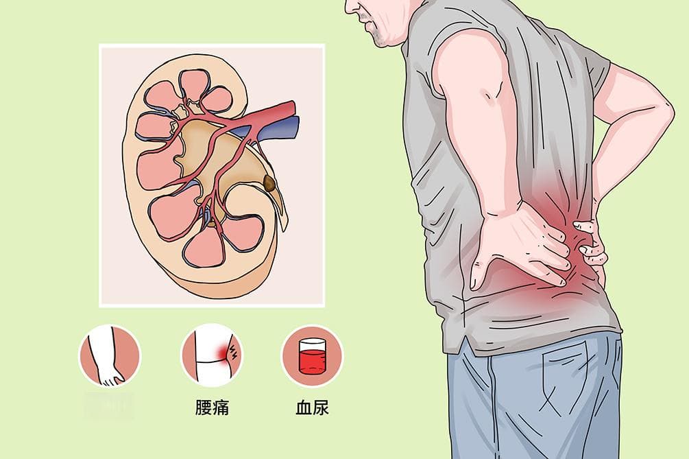 慢性肾病分期标准详解：从1期到5期的肾功能变化与临床表现