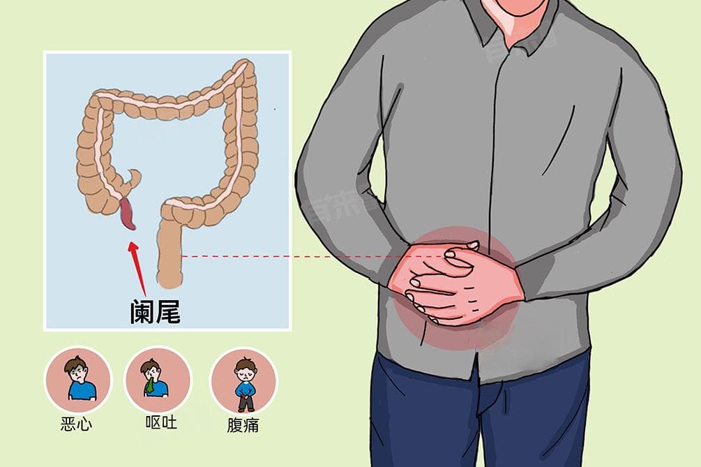 阑尾炎手术几天可以出院
