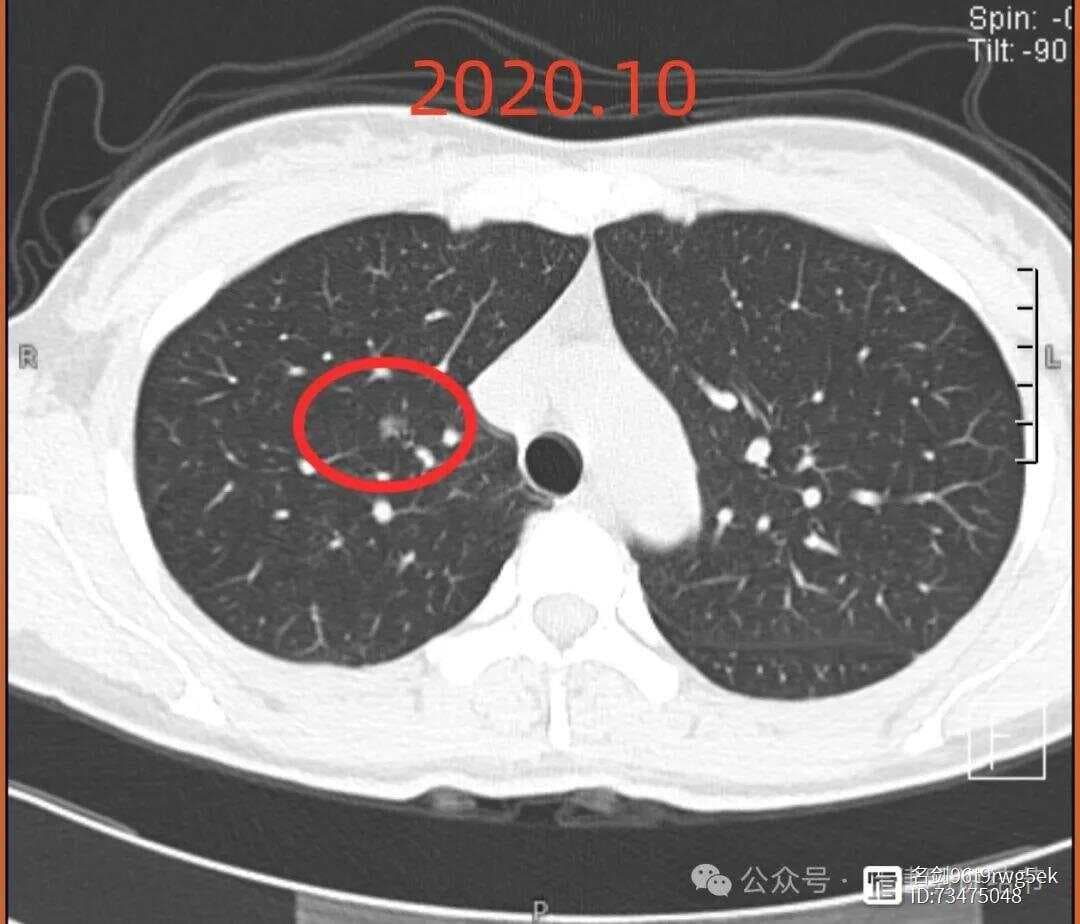 肺结节是否需要手术？专家解析多发结节处理争议