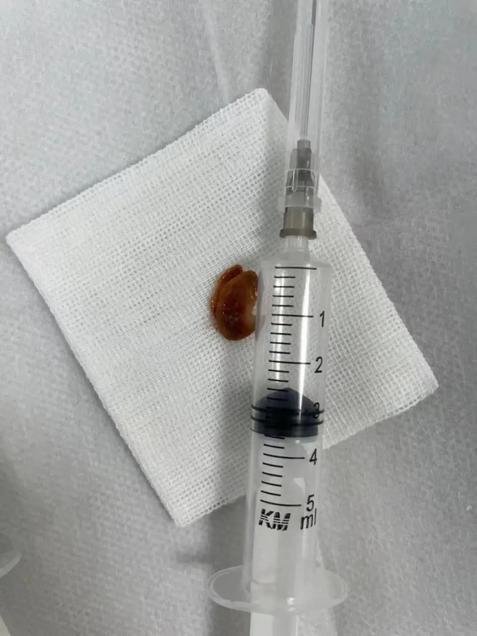 10岁男孩反复咳嗽发烧找病因，“罪魁祸首”竟是一颗南瓜子！