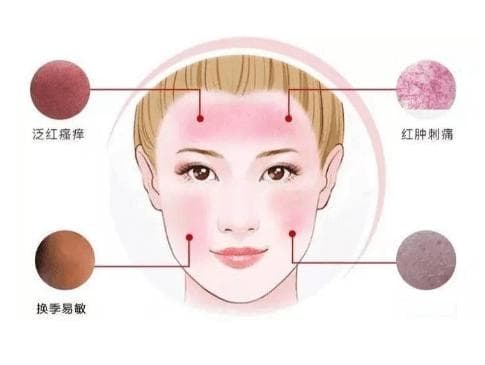 油敏肌与干敏肌的护肤指南
