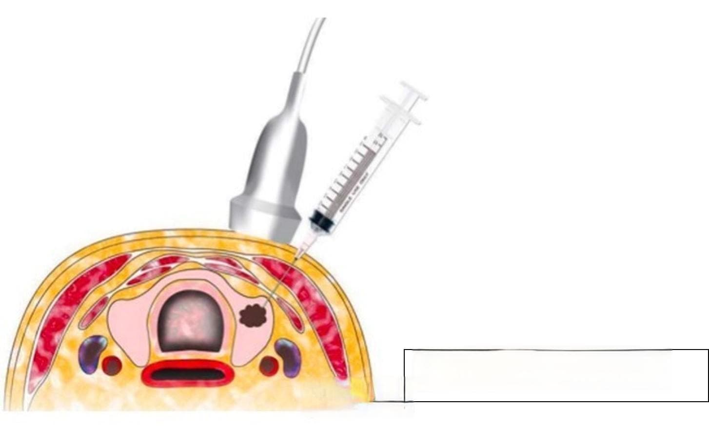 细针穿刺细胞学诊断甲状腺癌价值及评价