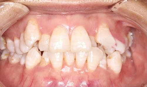 科普帖：牙齿伸长磨了好还是压回去好？上牙压低4mm容易实现吗？