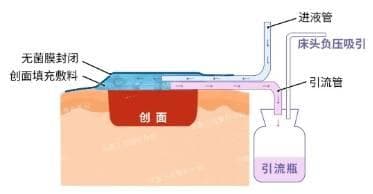 VSD负压封闭引流术：整形外科治疗慢性创面的新选择