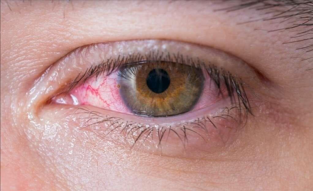 细菌性结膜炎需用药，专家提醒：这些症状别轻视