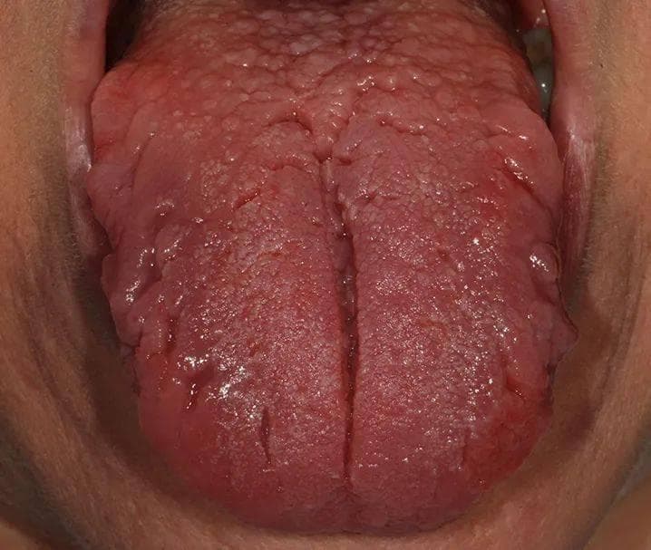 舌头有裂纹，是大病前兆？真相其实是这样的