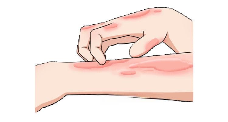 烧伤后瘙痒：用肉毒还是用曲安？