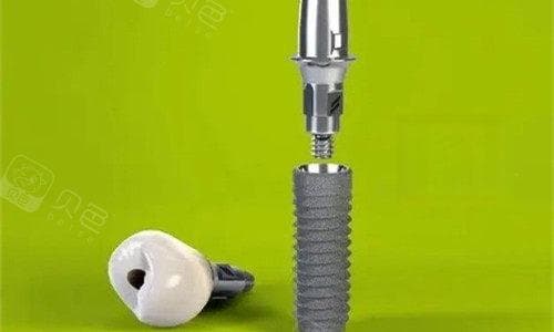 牙齿缺失很久了还能种牙吗？详细介绍牙齿缺失种植牙解决方案